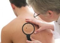 Dermatolog bada znamię na skórze młodego dorosłego